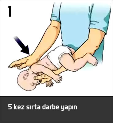 bebeklerde heimlich manevrası